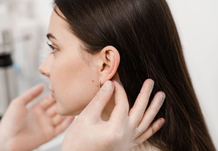 Otoplastie : Corriger la Forme de Vos Oreilles en Toute Confiance